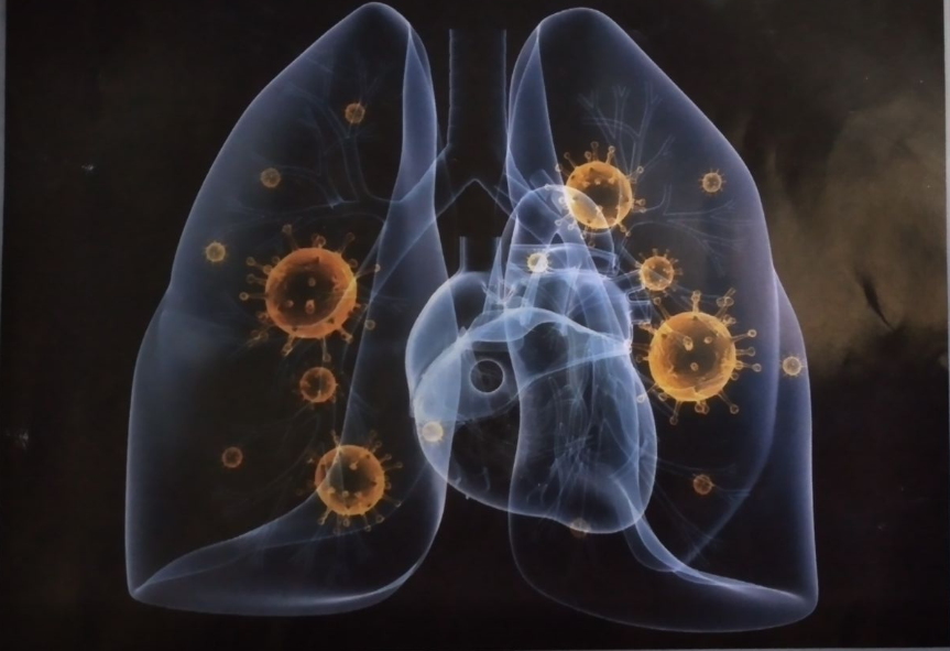 Bukan TBC atau asma ? tangani pneumonia pada anak dan cara pencegahannya